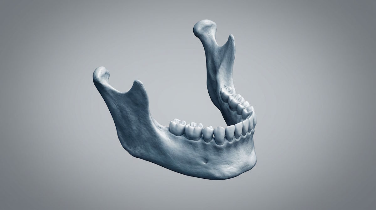 Трехмерное изображение челюсти на компьютерной томографии